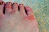 my foot infected with a few Hookworm parasites