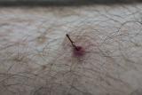 Half inch African boxthorn spine in the back of my calf for a fortnight. Quick scrape and a squeeze and it just ... slid ... out