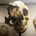 A skull with rare bone cancer (Chordoma)