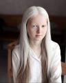 A girl with albinism and heterochromia