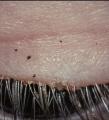 Pubic lice living in a persons eyelashes.