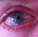 Eye with an artificial cornea after keratoprosthesis
